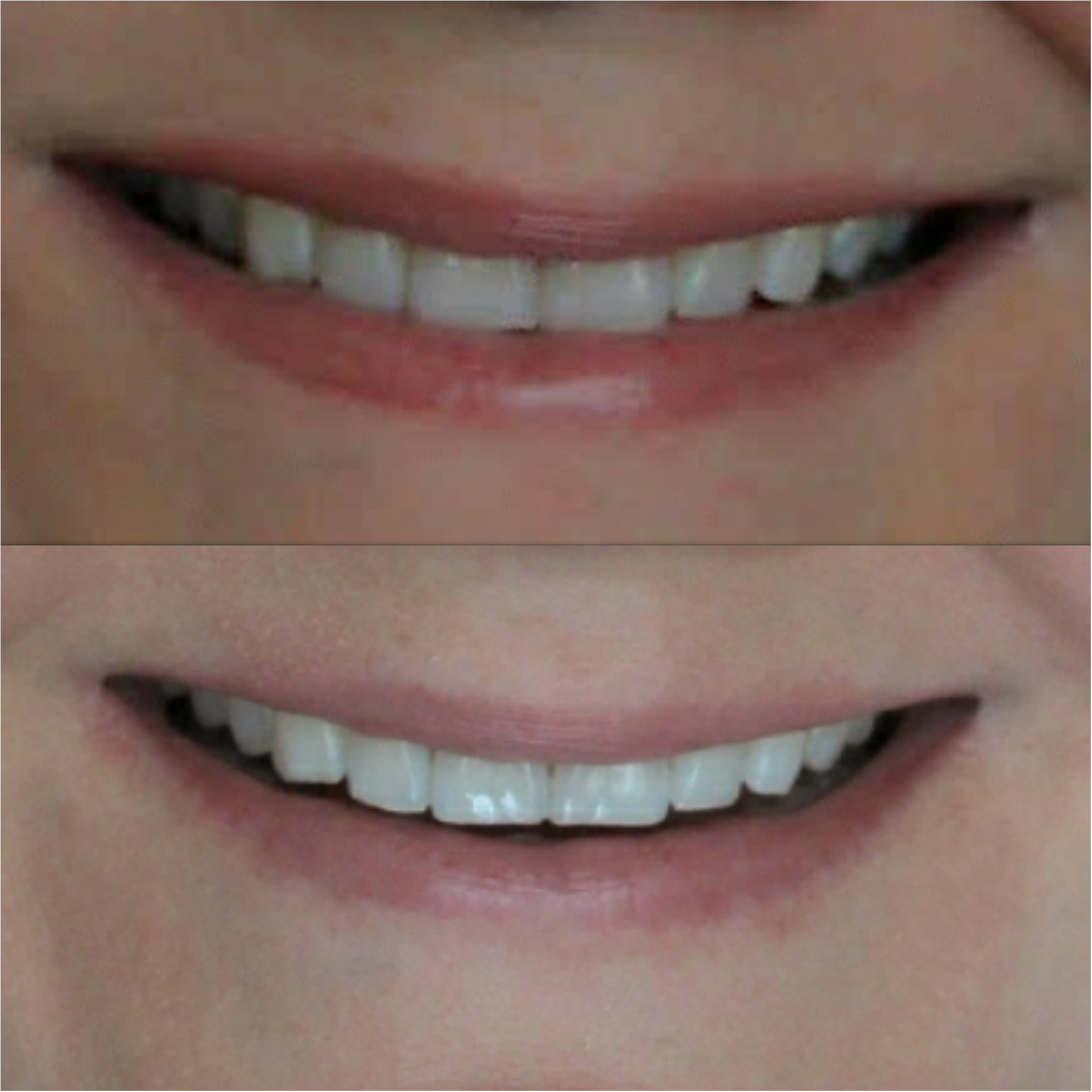 At-home-teeth-whitening-does-it-work-fabulouslyoverdressed